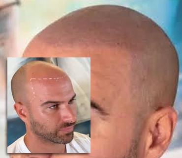 Micropigmentación capilar, resultado