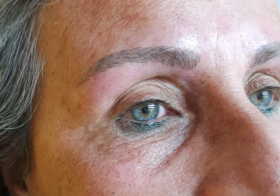 Microblading de cejas sobre rostro con alopecia superciliar