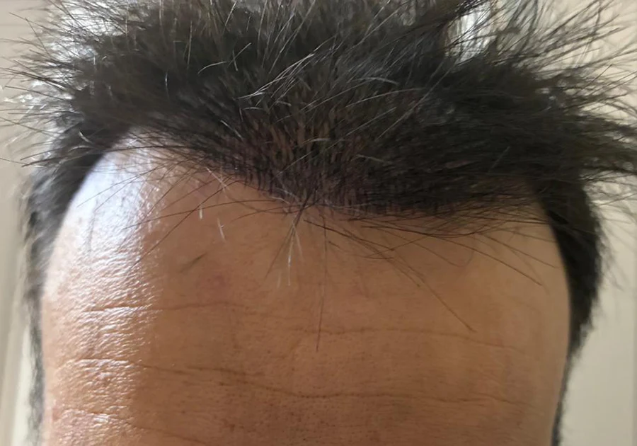 Micropigmentación paramédica para alopecia capilar